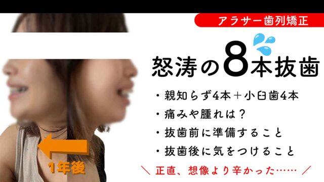 【歯列矯正】怒涛の８本抜歯体験談！痛みは？腫れは？気をつけることは？